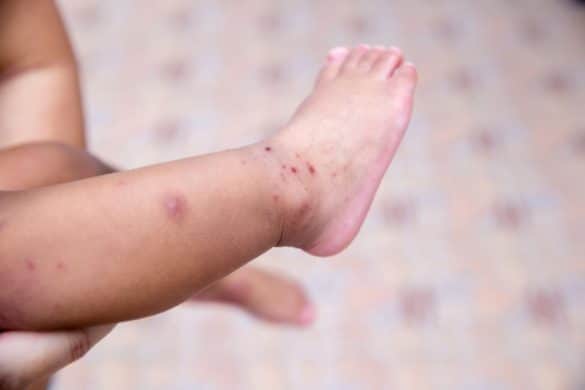 Syndrome pied-main-bouche : traitements naturels pour adultes et enfants